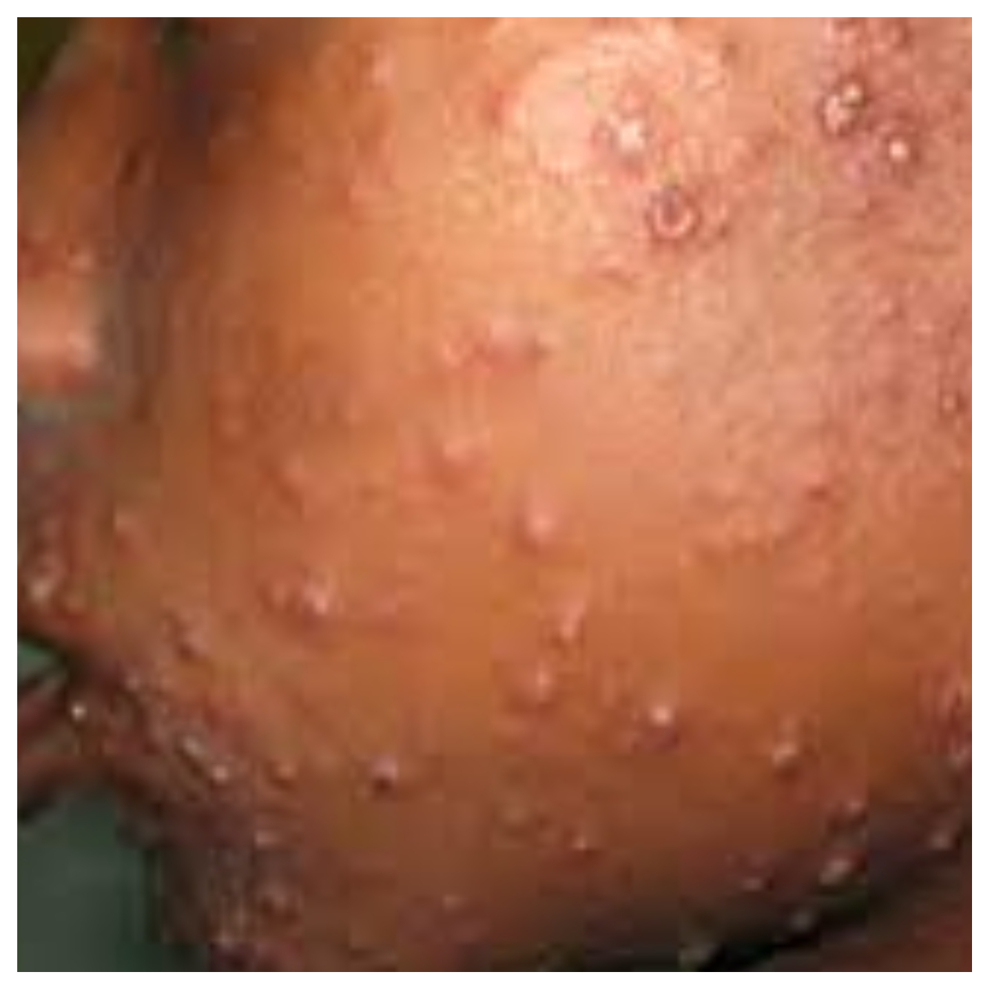 How to prevent measles infection —Experts