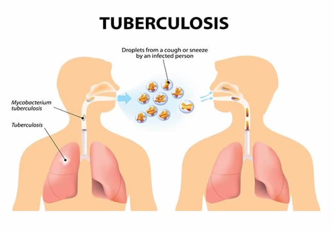 World TB Day: WHO urges better access to tuberculosis prevention, treatment 