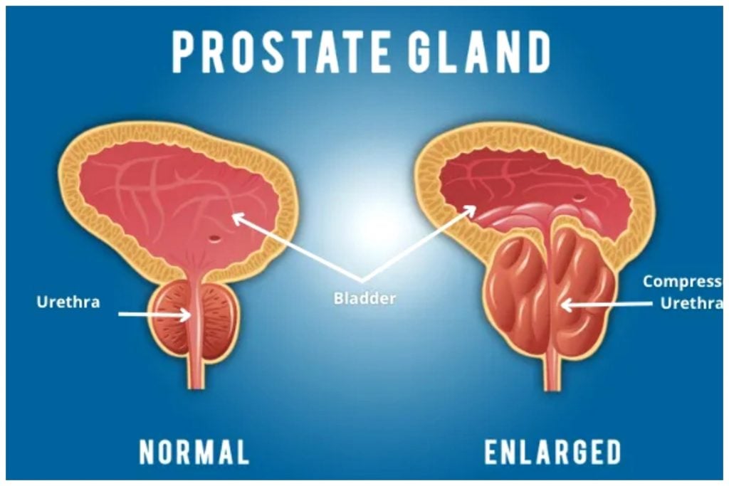 Painful ejaculation may be sign of prostate cancer – Physician 