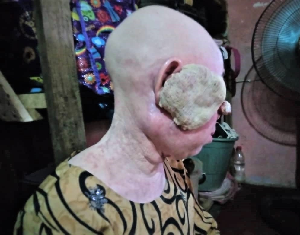 Stay away from sun to avoid skin cancer,  Foundation tells albinos