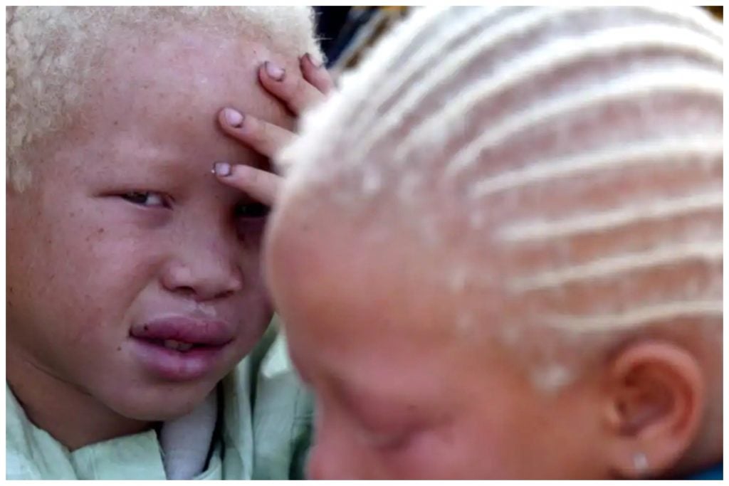 Skin cancer, vision loss, greatest challenges plaguing us – Albinism group