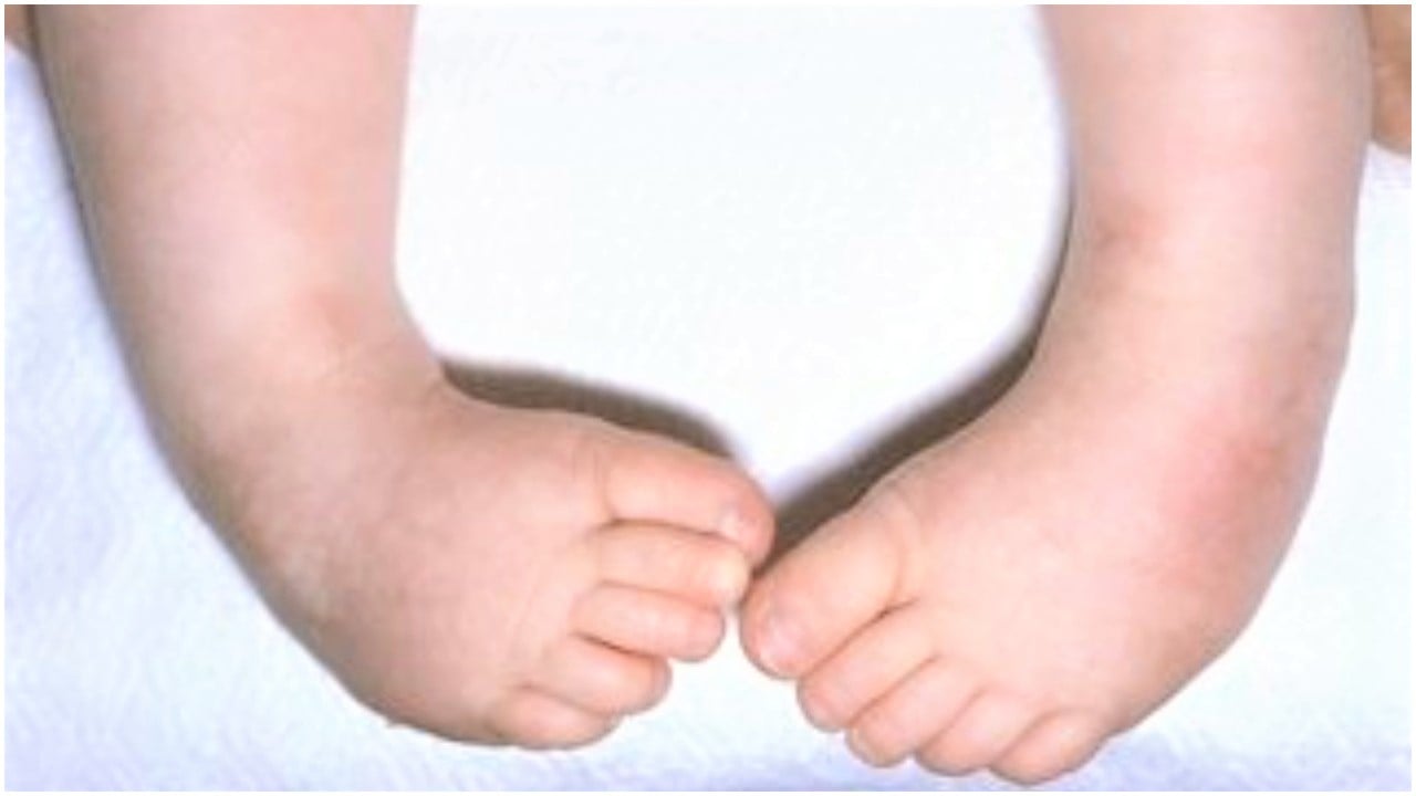 Expert warns against abandoning children with club foot